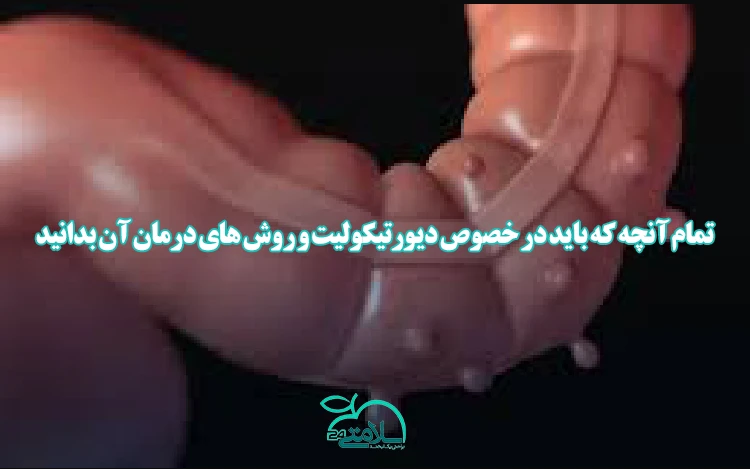 تمام آنچه که باید در خصوص دیورتیکولیت و روش های درمان آن بدانید