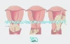 تمام آنچه که باید درباره سرطان فرج یا مهبل (پرینه) بدانید