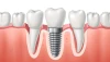 بهترین متخصص ایمپلنت در تهران