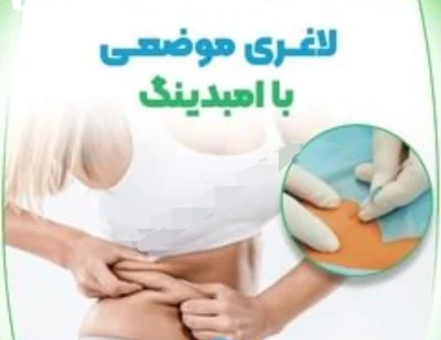 امبدینگ لاغری بدون درد و بدون رژیم