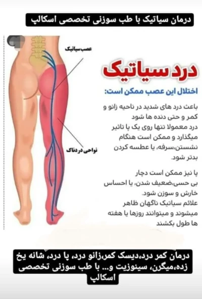 درمان سیاتیک با طب سوزنی