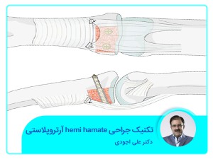 تقنية رأب المفاصل Hemi Hamate