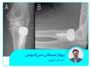 بدلة إسمنتية ذات رأس نصف قطر